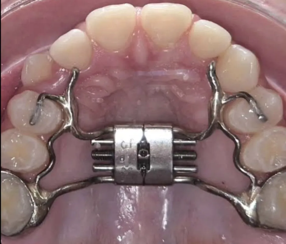 Aparelho ortopédico expansor instalado no palato