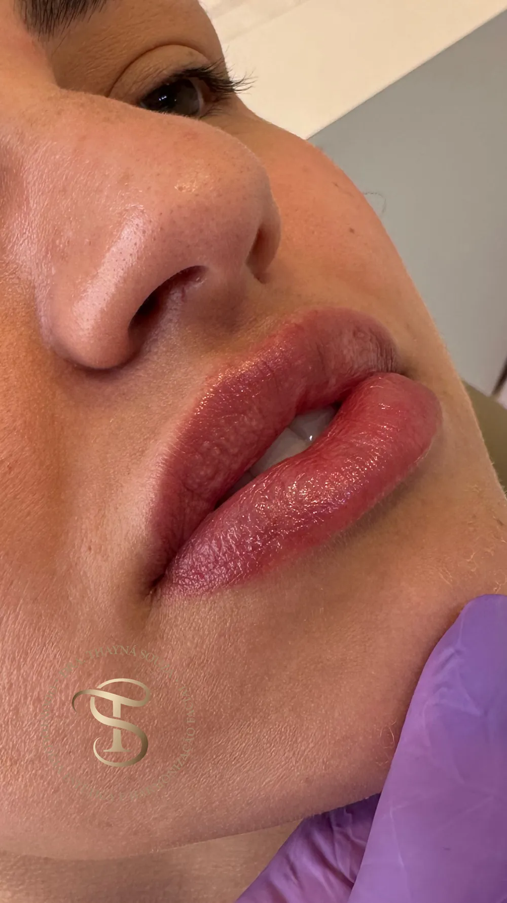 Resultado de preenchimento labial com ácido hialurônico