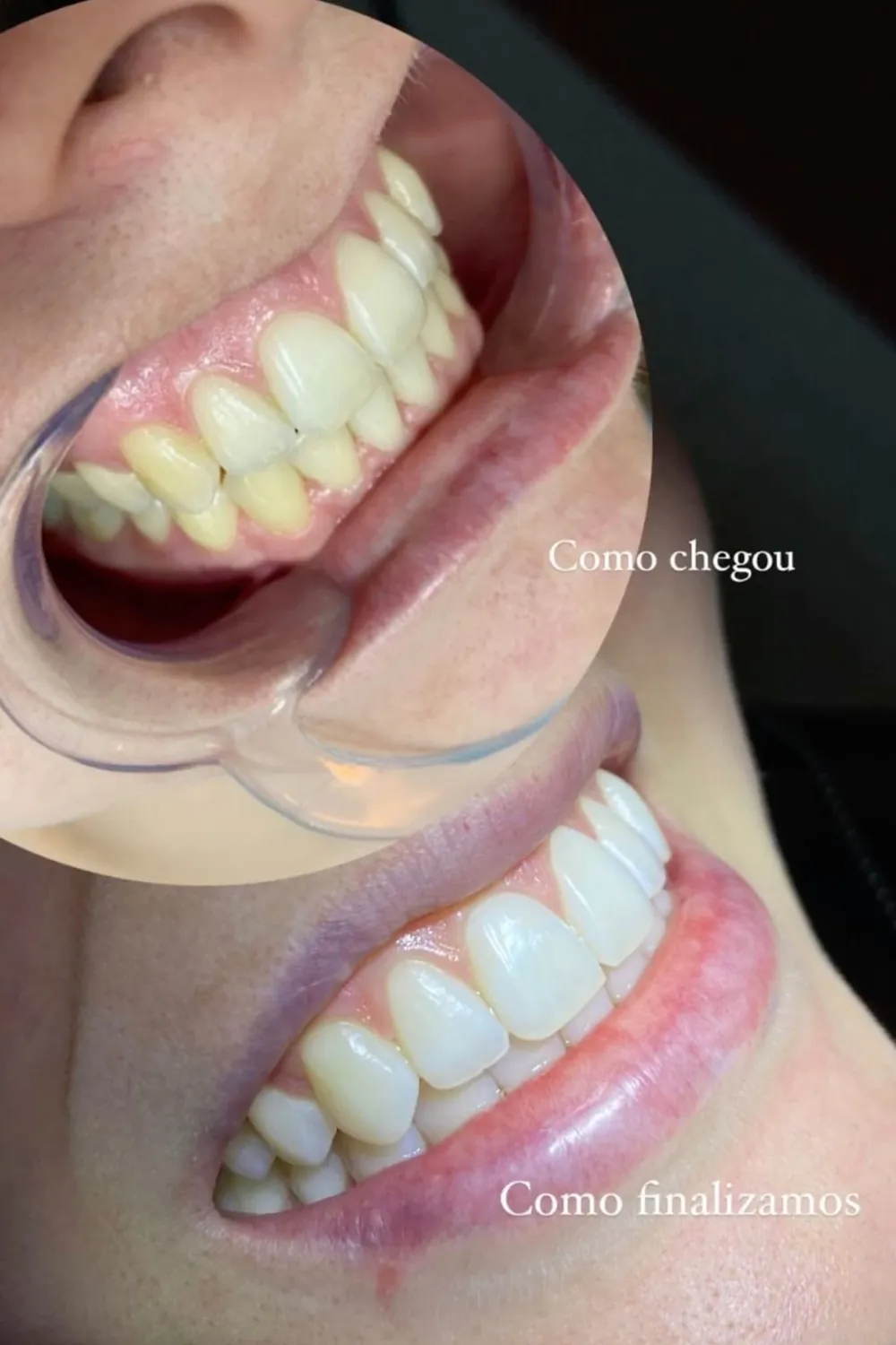 Antes e depois de tratamento ortodôntico, sorriso alinhado