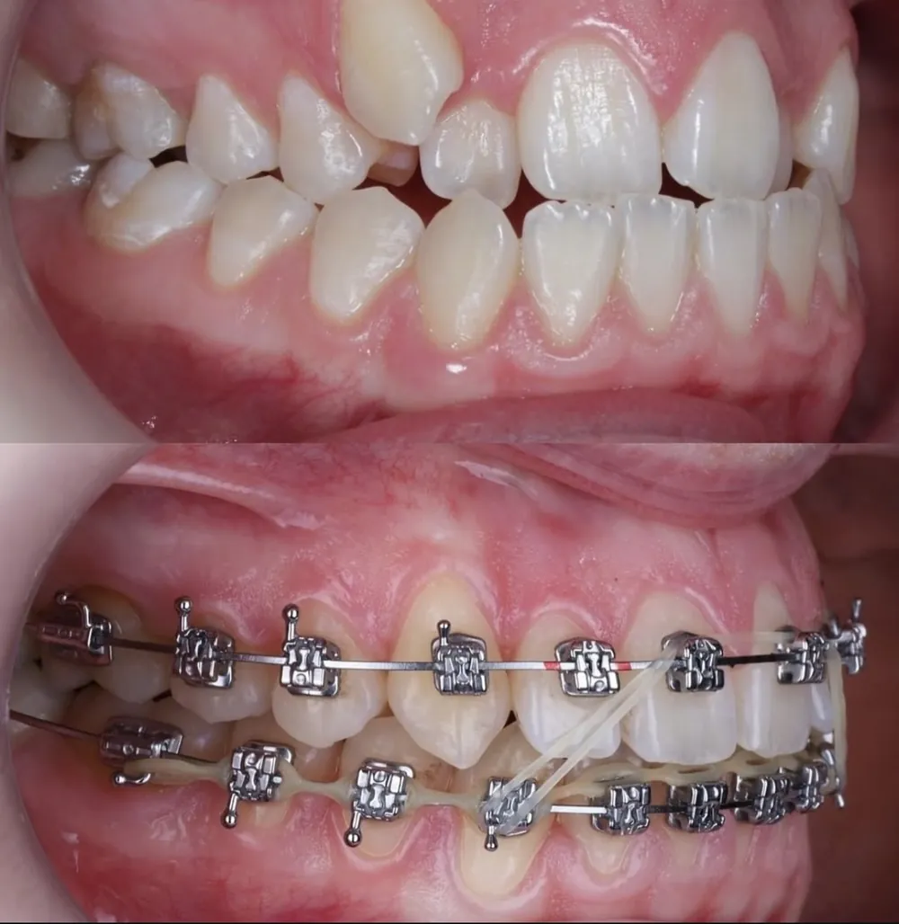 Dentes apinhados antes e durante o tratamento com aparelho fixo