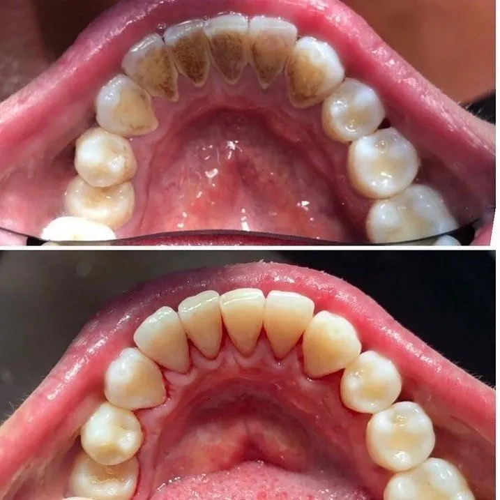 Antes e depois do alinhamento da arcada dentária com ortodontia