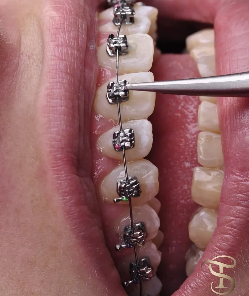 Aparelho ortodôntico fixo em detalhe, durante o atendimento