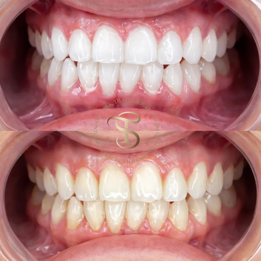 Resultado de tratamento ortodôntico, sorriso em oclusão